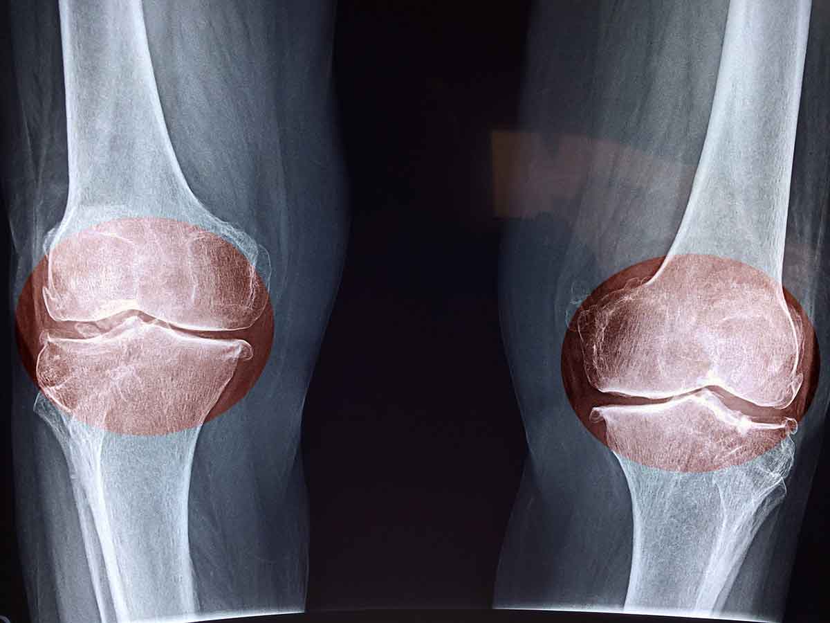 X-ray image of knee joints with red-colored joints